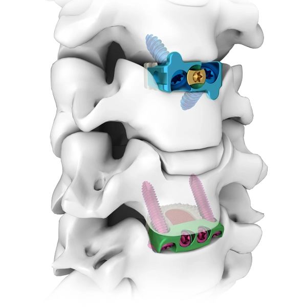 ゼロプロファイル前頸椎椎間ロッキングプレートとケージの組み合わせシステム