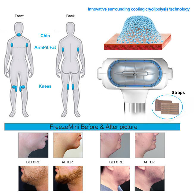 cryo slimming machine for sale