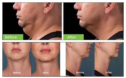 double chin reduction machine